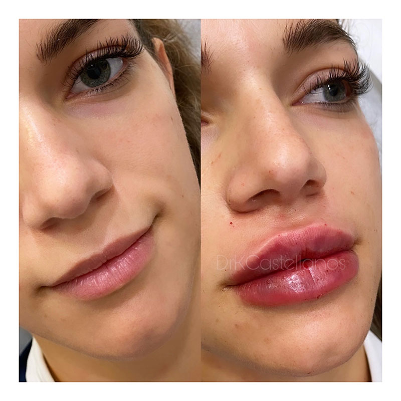 Lips Hydration Before & After Results – KC Medical Aesthetics